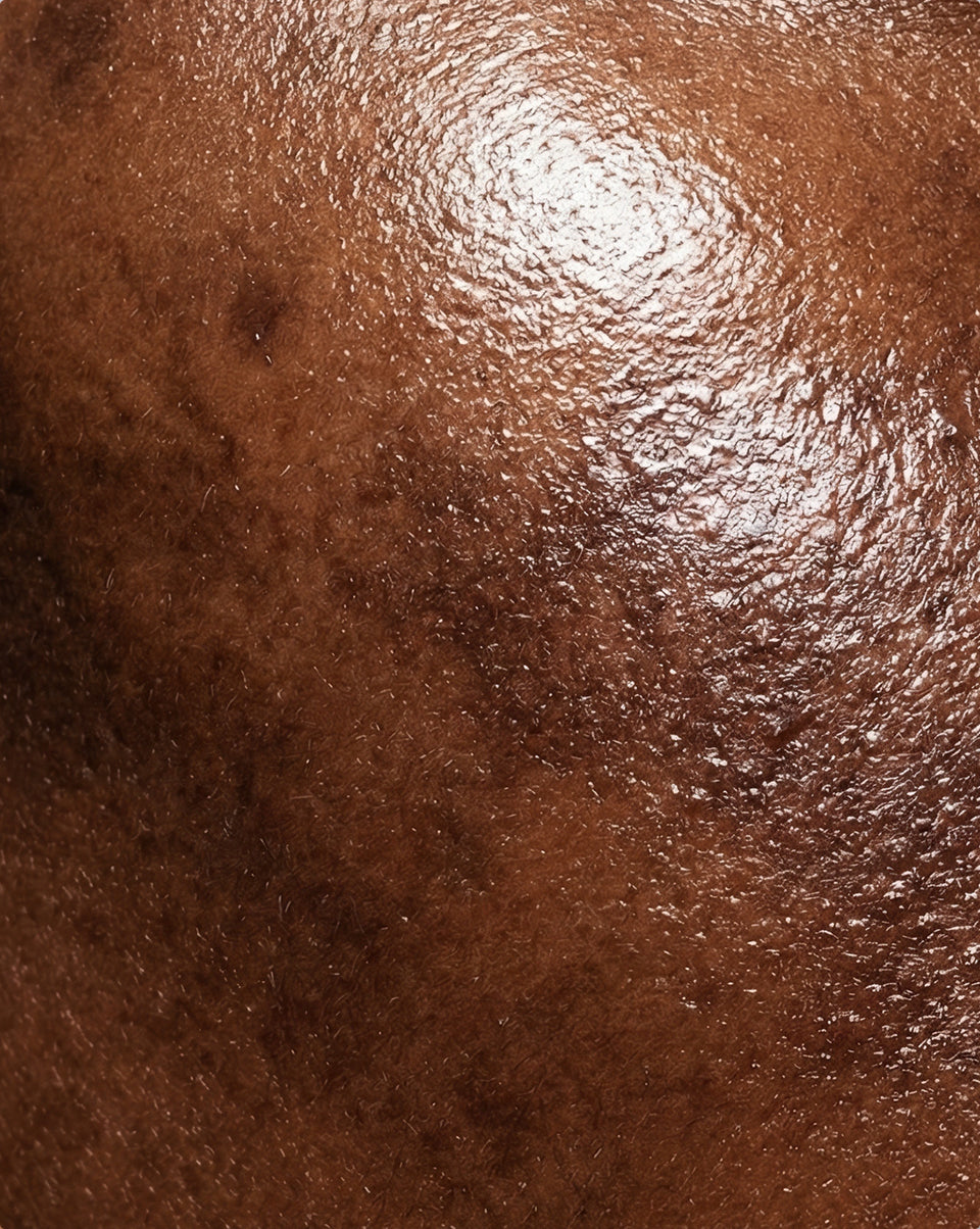 Pigmentation, Uneven Tone & Melasma