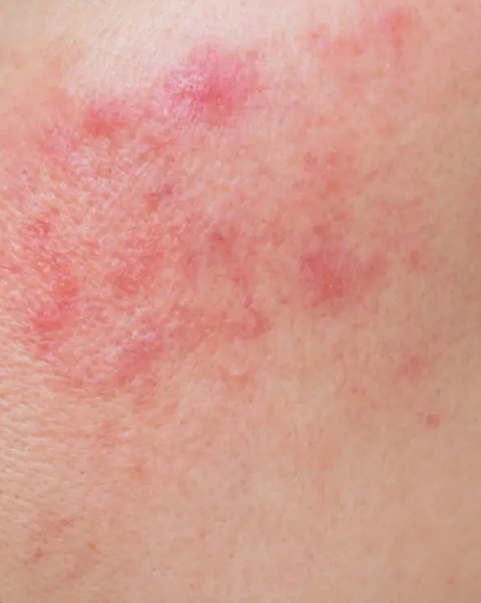Redness & Rosacea